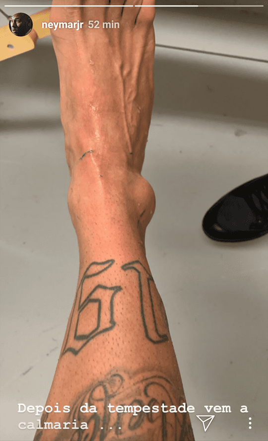 Neymar publicou foto do tornozelo machucado (Foto: Reprodução/Instagram) Neymar publicou foto do tornozelo machucado (Foto: Reprodução/Instagram)